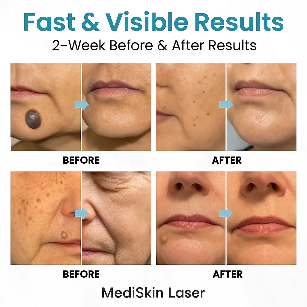 MediSkin Laser